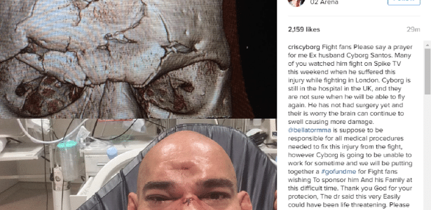 Atleta sofreu grave lesão no crânio após levar joelhada voadora - Reprodução/Instagram