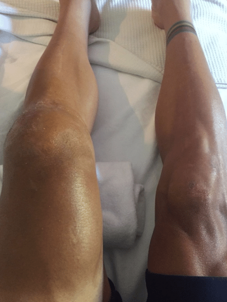 O ciclista Philippe Gilbert mostra o joelho esquerdo inchado após queda na Volta da França - Reprodução/Instagram