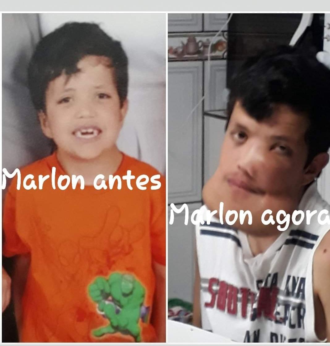 Marlon André Krenkel tem querubismo - Arquivo pessoal