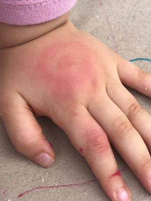 Luciana Crozetta, de Orleans (SC), e família, pegaram doença de Lyme - Arquivo pessoal - Arquivo pessoal