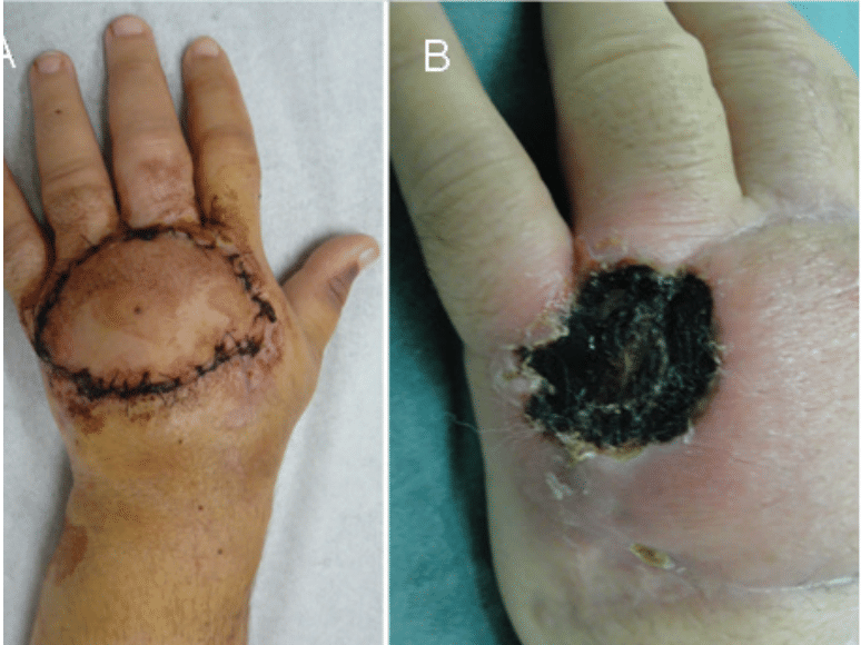 Ótima evolução inicial com uma integração completa do retalho (A). Após um período de quatro semanas apareceu uma área de necrose no dorso da mão (B) - Revista Brasileira de Dermatologia
