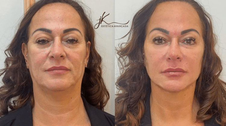 Nadine Gonçalves, mãe do Neymar, fez uma harmonização facial na JK Estética Avançada