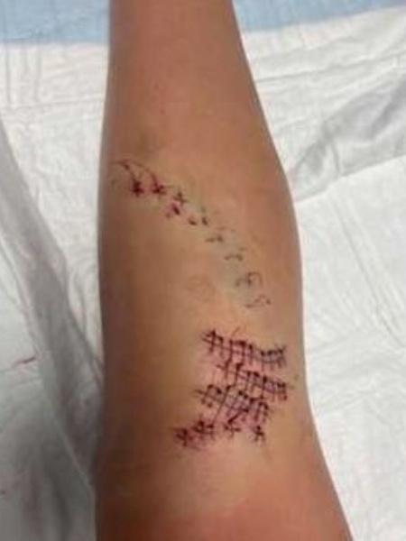 Imagem da perna da garota atacada pelo tubarão - Reprodução/WBAL-TV