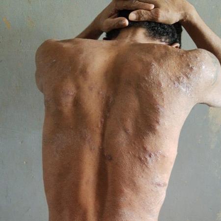 Segundo o governo de Roraima, os presos têm uma infecção de pele causada por bactérias - OAB/RR