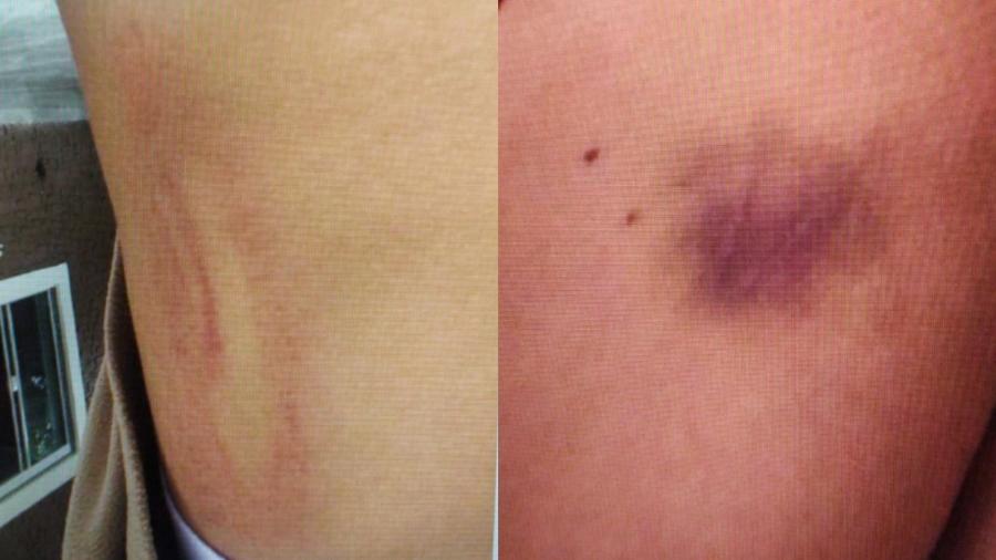 Fotos tiradas pelas vítimas mostram marcas de agressão no corpo - Divulgação/Polícia Civil
