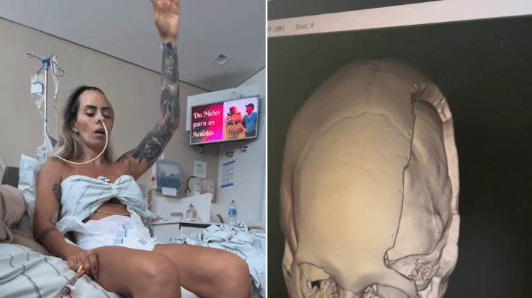 À esquerda, Danielle durante a recuperação após o AVC. À direita, a prótese que recebeu no local onde o crânio havia sido removido
