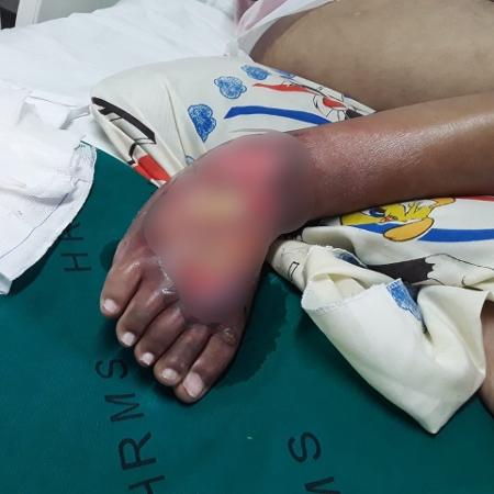 Homem foi liberado do hospital com uma infecção no pé, em Campo Grande (MS) - Arquivo Pessoal
