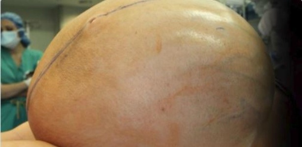 Uma mulher de 38 anos passou por uma cirurgia para retirar um tumor gigante - Danbury Hospital/CNN