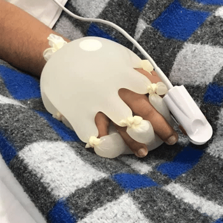 Técnica da "mãozinha", com luva cirúrgica "entrelaçada" a paciente, viralizou nas redes sociais - Reprodução/Redes Sociais