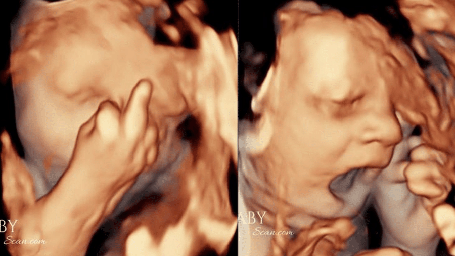 Bebê tem reações curiosas ao ser fotografato em ultrassom - Reprodução/Kennedy News and Media