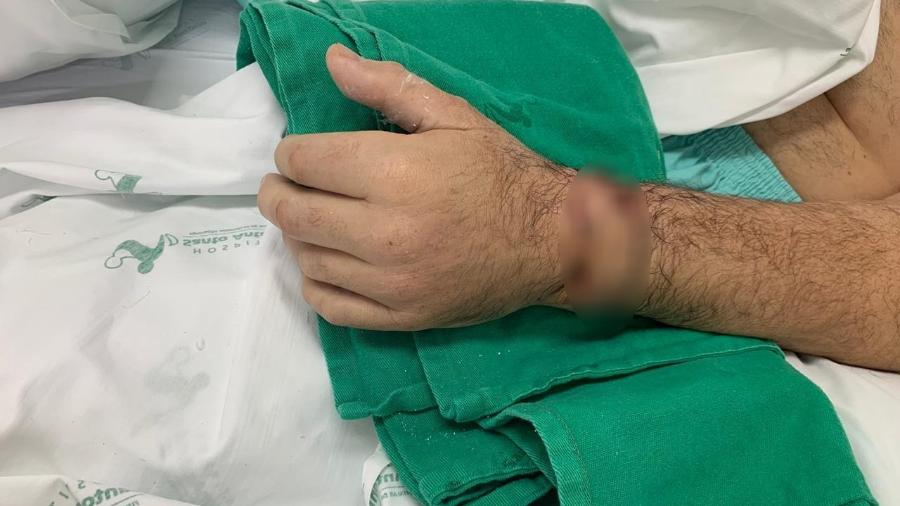Homem teve mão reimplantada após conseguir preservá-la com gelo - Divulgação/Hospital Santo Antônio