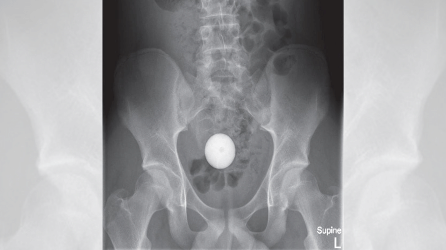 Raio-X mostra bola de golfe presa no cólon de adolescente - Reprodução/Hidawi Case Reports in Surgery