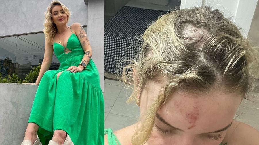 A influenciadora Iara Gramin, 27, ficou com hematomas pelo corpo e teve o cabelo puxado por uma das agressoras - Arquivo pessoal