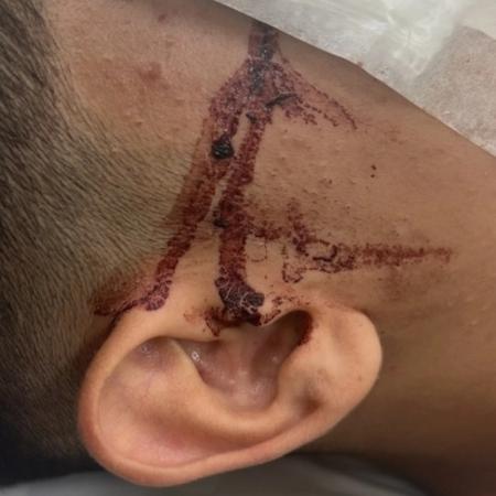 Adolescente perdeu a visão do olho direito após ser atingido por barra de metal dentro em escola de SP Adolescente perdeu a visão do olho direito após ser atingido por barra de metal dentro em escola de SP
