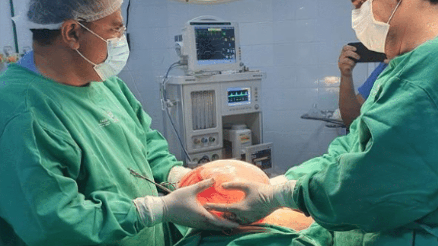 Cisto de 5 kg retirado de ovário de idosa - Reprodução/Hospital Regional de Bom Jesus
