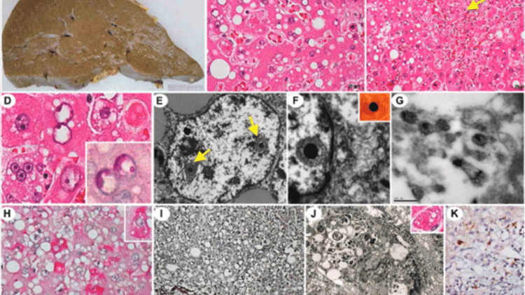 Patologia da infecção grave pelo SABV. Imagens mostram fígado danificado e detalhes do vírus