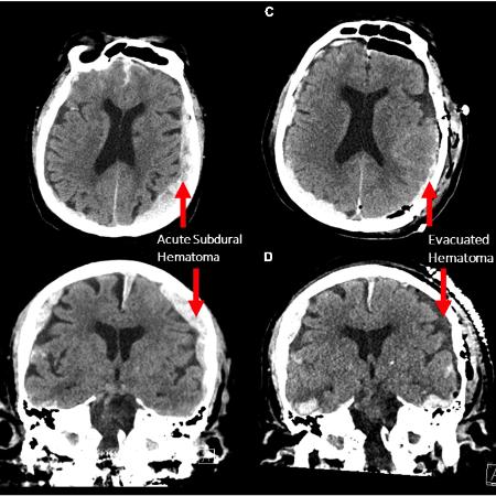 Tomografia do cérebro de paciente avaliada pelos cientistas durante a pesquisa. - Reprodução/Frontiers