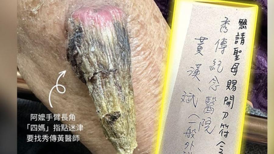 Formação como a de um chifre, que é rara, cresce em braço de idosa em Taiwan - Reprodução/Facebook
