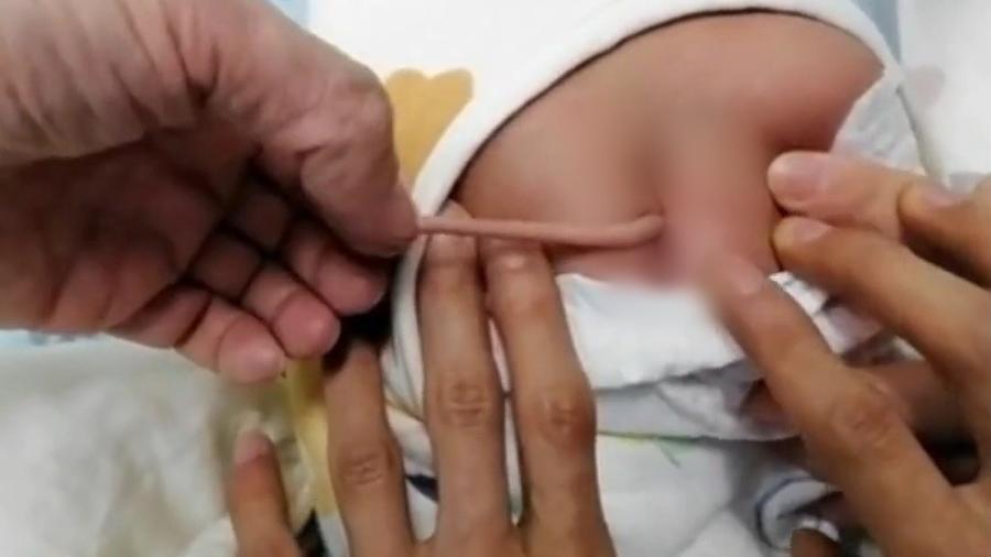 Bebê nasceu com problema no sistema nervoso, que acabou gerando 'cauda' 