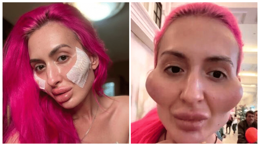 A ucraniana Anastasia diz que realiza os procedimentos na face porque gosta do que vê - Reprodução/Instagram