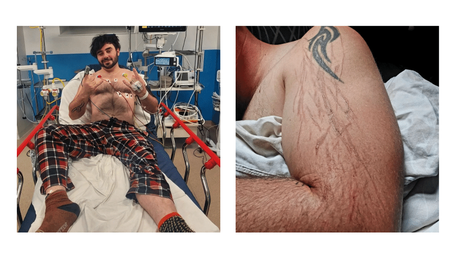 Aidan Rowan, 33, ficou com marcas características de um corpo humano atingido por um raio no braço, na mão e em um dos pés - Reprodução/Instagram