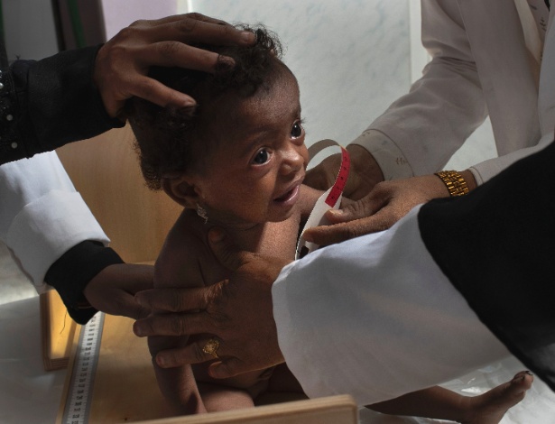 18.out.2018 - Criança desnutrida em uma clínica móvel em Aslam, no Iêmen - Tyler Hicks/The New York Times