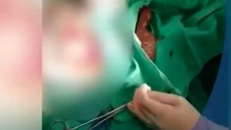 Chinês de 30 anos foi hospitalizado com uma tilápia de 20 centímetros introduzida no ânus - Reprodução - Reprodução