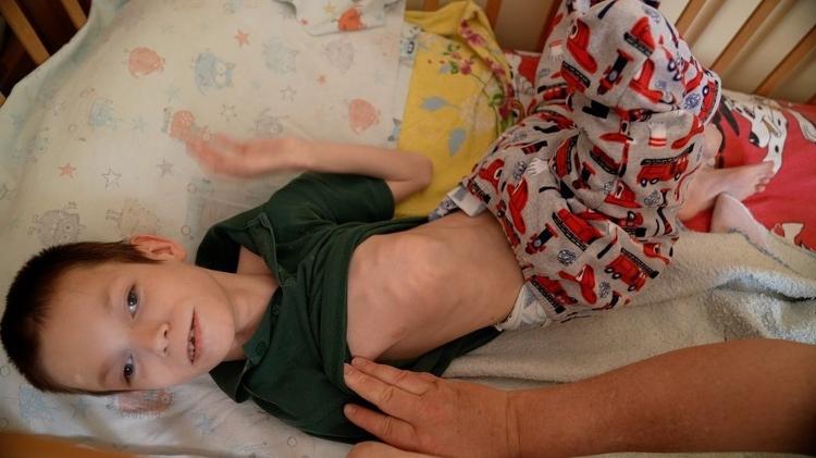 Boy's ribs are a sign of malnutrition - BBC NEWS - BBC NEWS