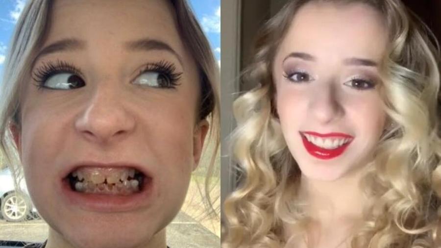 Jovem de 19 anos usou redes sociais para mostrar mudança após cirurgia de implantes nos dentes - @mihaley.olivia.grace/TikTok