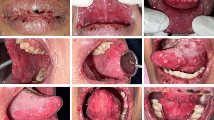 Quadro clínico da paciente na primeira consulta: ( A ) crostas nos lábios, área erosiva no canto direito da boca com tendência a sangrar; ( B – I ) úlceras brancas com bordas amareladas, formato irregular e tamanhos variados nas mucosas labial, bucal, lateral e ventral da língua e assoalho da boca.