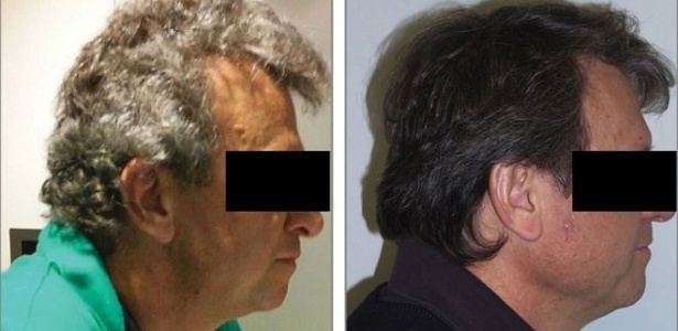 Dos 52 pacientes com câncer de pulmão, 14 tiveram mudanças na pigmentação do cabelo - Jama Network/American Medical Association