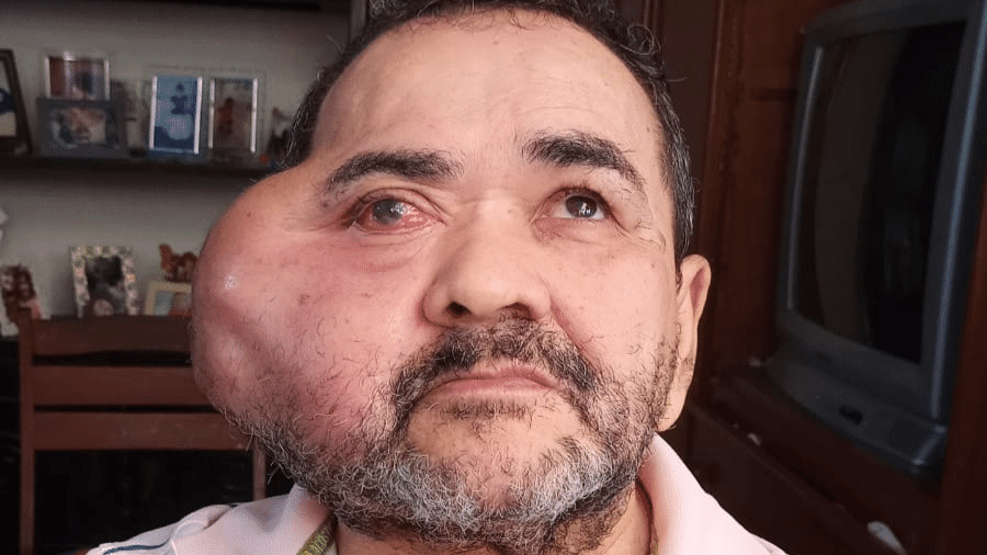 José tenta retirar um tumor gigante que ocupa quase metade de seu rosto; casos do tipo tem precedentes no Brasil e no exterior