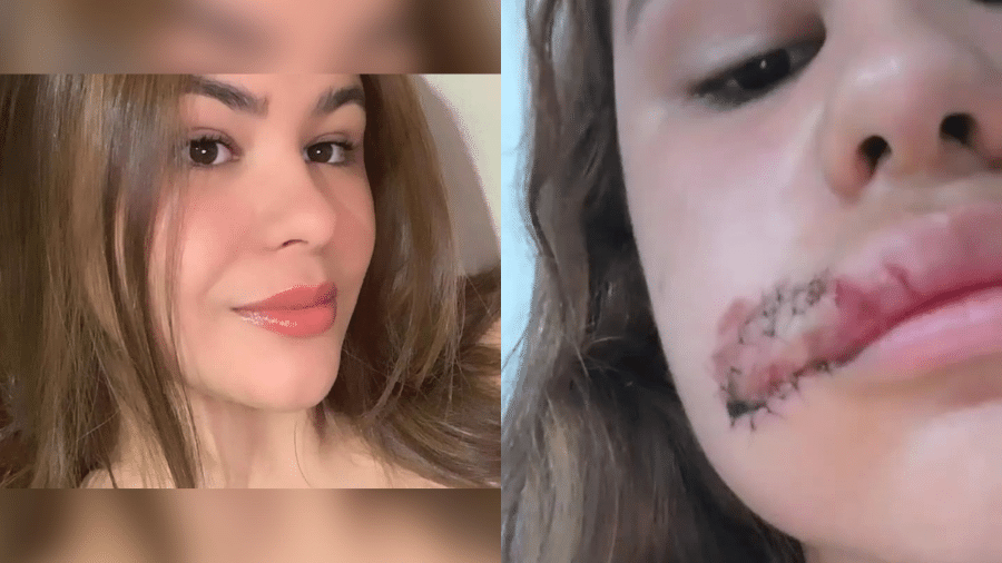 Alyna tem 18 anos e levou 14 pontos no rosto durante uma tentativa de assalto em Maceió (AL) - Reprodução/Instagram