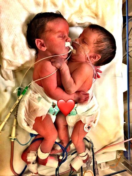 As gêmeas siamesas Eloá e Sara nasceram com 4,2 kg - Arquivo Pessoal