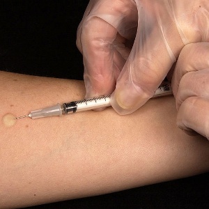 Teste mantoux, para detecção da tuberculose - CDC/Wikimedia Commons