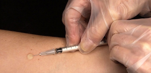 Teste Mantoux, para detecção de tuberculose - CDC/Wikimedia Commons