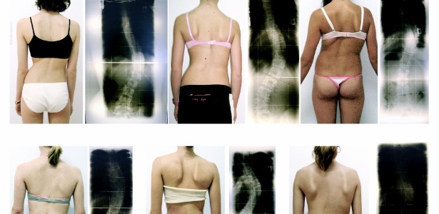 Fotos mostram diferentes padrões radiológicos e clínicos de pacientes do Projeto Escoliose - Divulgação/Projeto Escoliose