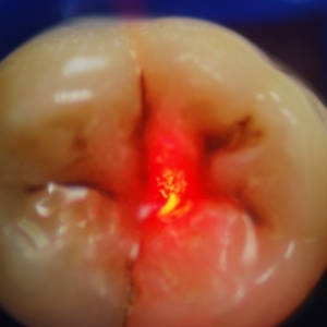 Aplicação de laser em dente - a técnica ainda não possui autorização da Anvisa - Divulgação