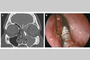 Sinusite e a dor de dente