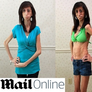 Mulher Com 26 Quilos Sofre De Sindrome Rara Que Nao A Deixa Engordar 10 11 2013 Uol Noticias