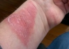 Usuários da pulseira fitness Fitbit relatam irritações e feridas na pele - Reprodução/Huffington Post