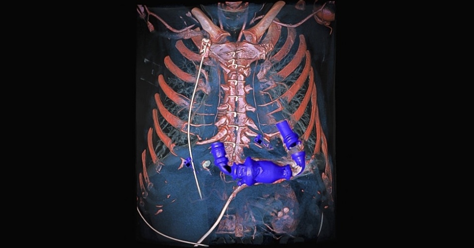 12.mar.2014 - Acima, imagem feita por Anders Persson mostra uma bomba cardíaca mecânica dentro de um tórax