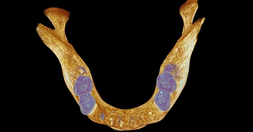 12.mar.2014 - Outra imagem de Kevin Mackenzie: a mandíbula inferior de um humano da época medieval