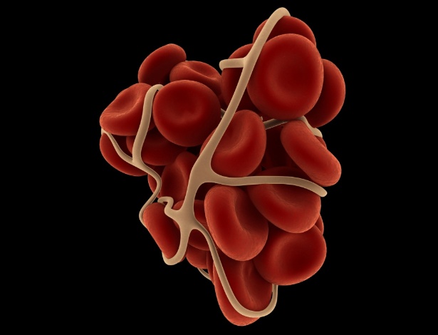 A TVP ocorre quando se forma um coágulo sanguíneo no interior das artérias ou veias profundas - Getty Images/iStockphoto