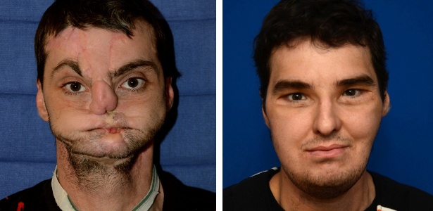 Richard Lee Norris antes (à esquerda), desfigurado por um acidente com arma, e 16 meses depois de um transplante de face em 2012; a primeira revisão sobre o tema mostra que o procedimento em geral é seguro  - New York Times