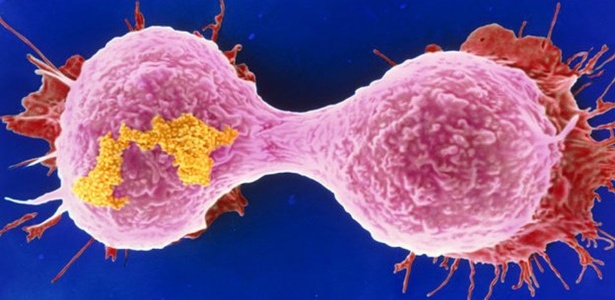 Mutação genética que leva à leucemia também pode causar câncer de mama agressivo - BBC
