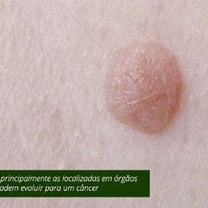 Fotos Mitos E Verdades Sobre Verrugas 14 07 2014 Uol Noticias