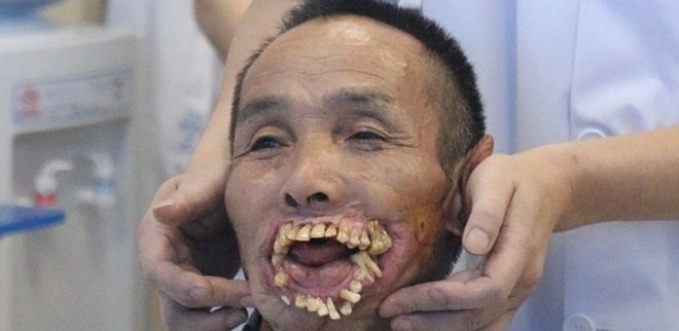 Cirurgia de Xiuyou Wu, 65, vai reconstruir lábios usando músculos das pernas - HAP/Quirky China News/REX