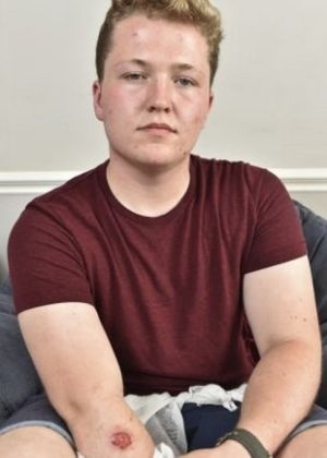 Jake Parker, 18, queimado pelo iPhone - Reprodução/Daily Mail