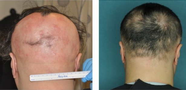 Tratamento reverteu queda de cabelo em pacientes com doença autoimune - Julian Mackay-Wiggan/Live Science/Reprodução